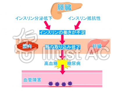 糖尿病イラスト 無料イラストなら イラストac